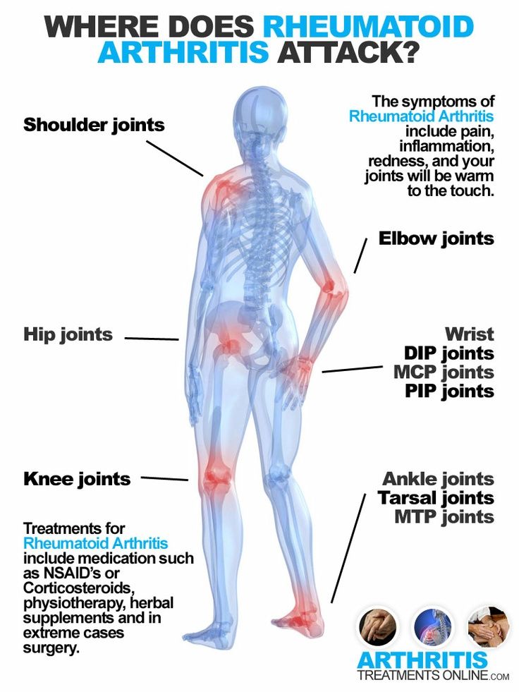 arthritis leg pain